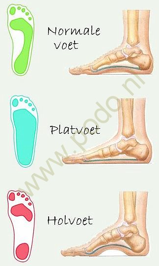 Commotie Rechthoek evenwicht Aandoeningen Artsenwijzer - Platvoeten en doorgezakte voeten | Podocentrum  Groene Hart